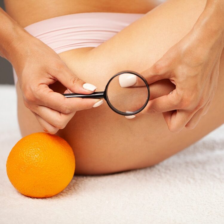 guida alla cellulite